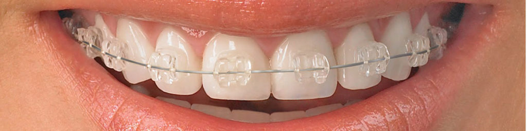 Clear Glass Braces