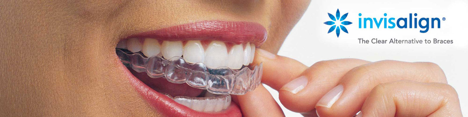 Invisalign Braces by Redhead Orthodontics