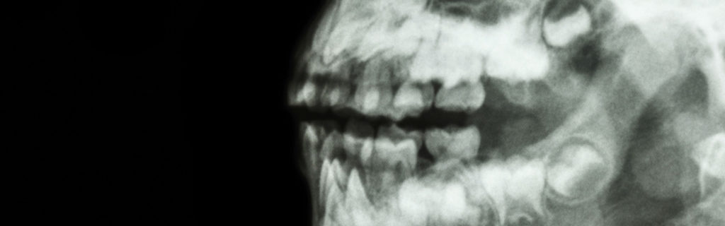 Redhead Orthodontics Orthognatic Surgery