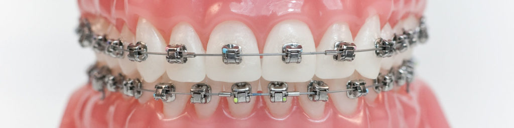 Damon Braces by Redhead Orthodontics