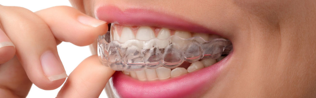 Invisalign Aligners by Redhead Orthodontics