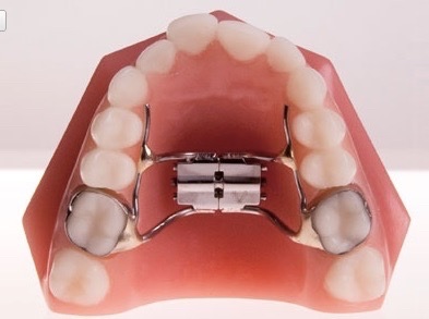 Palatial Expander by Redhead Orthodontics