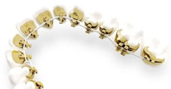 Hidden Lingual Incognito Redhead Orthodontics
