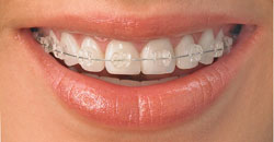 Redhead Orthodontics Clear Braces