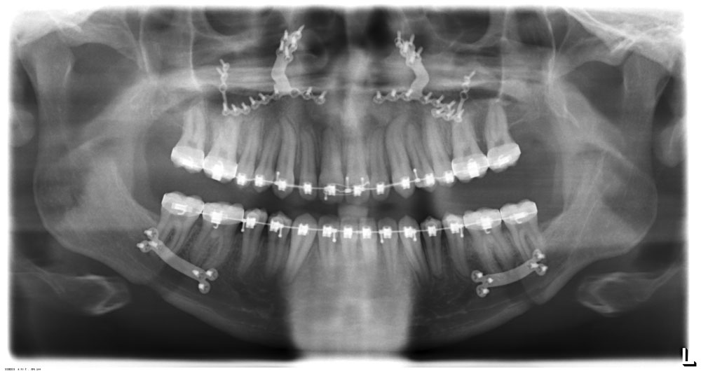 Redhead Orthodontics Fixation of the Bones