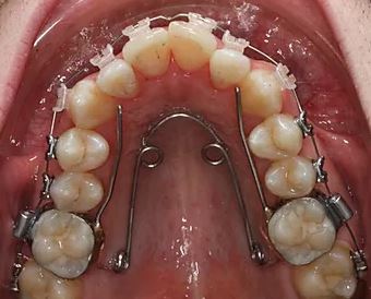 Redhead Orthodontics Quadhelix