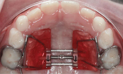 Redhead Orthodontics Rapid Maxillary Expander